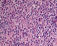 NLPHL with variant patterns progressing to DLBCL