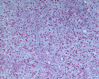 NLPHL-with-progression