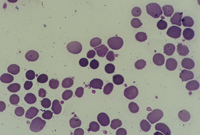 peripheral blood smear with spherocytic view 1