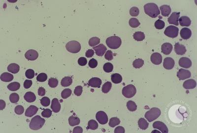 peripheral blood smear with spherocytic view 1