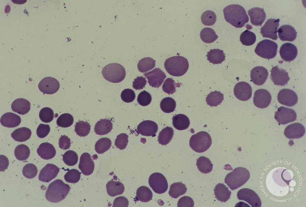 peripheral blood smear with spherocytic view 1
