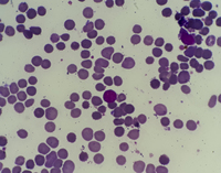 peripheral blood smear with spherocytic view 3