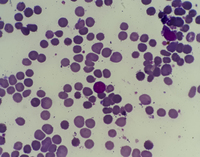 hemolytic disease of the newborn blood smear