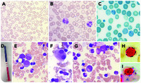 Acquired α-thalassemia associated with myelodysplastic syndromes