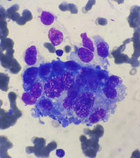 Hypocellular bone marrow with metastatic cells 3