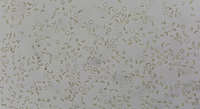 presence of thalassemia and sickle cell trait in a female patient 2