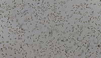 presence of thalassemia and sickle cell trait in a female patient 3