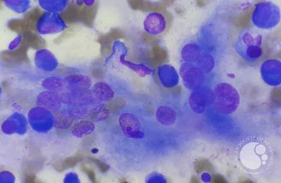 Presence of osteoclasts in multiple myeloma patients` sample