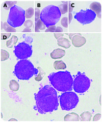 Microgranular variant of acute promyelocytic leukemia with cytoplasmic projections resembling micromegakaryocytes