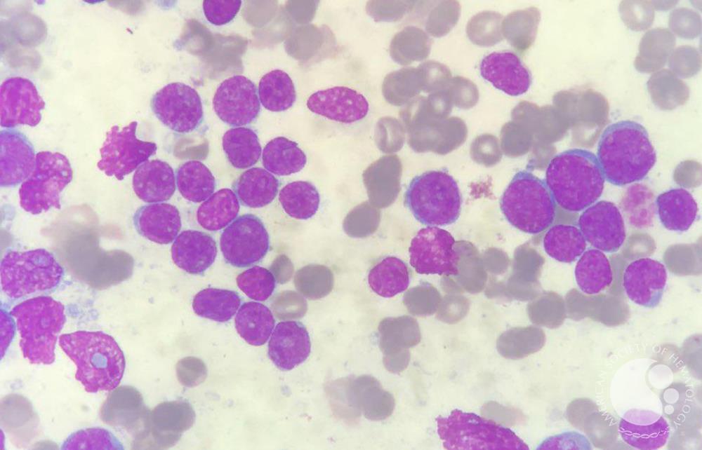 Bone marrow filled with blasts in acute lymphoblastic leukemia (ALL) patient 3