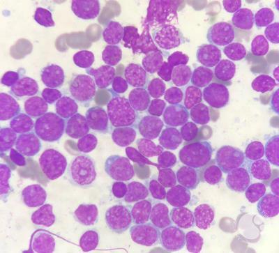 Bone marrow filled with blasts in acute lymphoblastic leukemia (ALL) patient 4