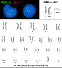 Karyotype and FISH of t(9;22) with t(3;3)