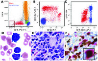 Mixed-phenotype acute leukemia, T/megakaryoblastic