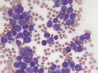 acute promyelocytic leukemia microgranular variant