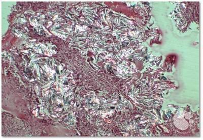 Oxalate crystals in bone marrow 3