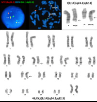 Karyotype and FISH of t(8;14)