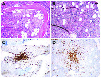 Systemic mastocytosis with an associated hematological neoplasm masquerading as overt primary myelofibrosis