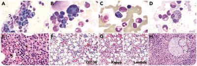 Idiopathic plasmacytic lymphadenopathy with polyclonal hypergammaglobinemia mimicking plasma cell myeloma