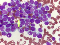 Alveolar Rhabdomiosarcoma Myelophthisis 1