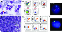 One translocation for 2 lymphoid neoplasms