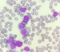 Myeloblast in Peripheral Blood Smear