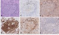 HHV-8 Multicentric Castleman Disease in HIV+ Patient