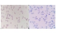 Moderate anisopoikilocytosis with Marked Reticulocytosis in a ß Thalassemia Intermedia child