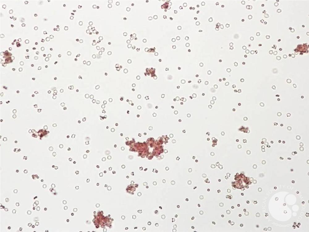 Mixed field Seen after O Rh Positive Red Cell Transfusion