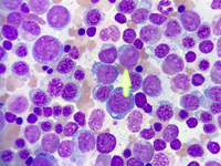 Acute Myeloid Leukemia with Myelodysplasia Related Changes