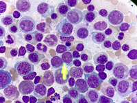 acute-myeloid-leukemia-with-myelodysplasia-related-changes