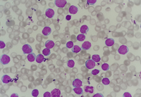 Chronic Lymphocytic Leukemia Cll With Presence Of Pro Lymphocytes 1