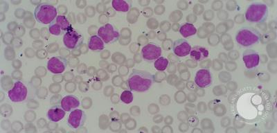 Chronic lymphocytic leukemia (CLL) with presence of pro-lymphocytes 3