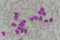 Chronic Lymphocytic Leukemia Cll With Presence Of Pro Lymphocytes 4