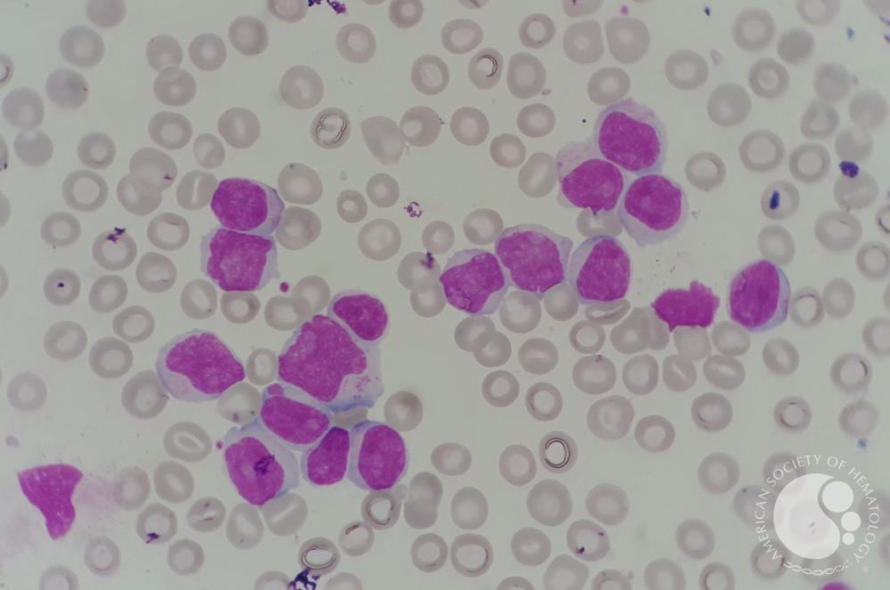 Chronic lymphocytic leukemia (CLL) with presence of pro-lymphocytes 4