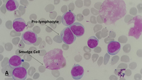 leukemia cll