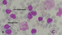 chronic-lymphocytic-leukemia-cll-with-presence-of-pro-lymphocytes-6