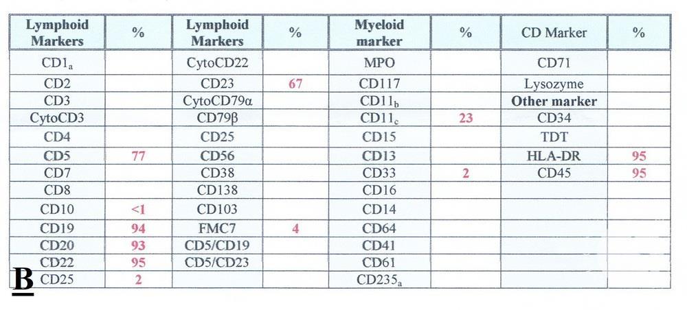 Chronic lymphocytic leukemia (CLL) with presence of pro-lymphocytes 7