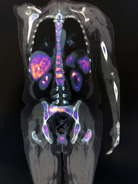 Breast Cancer Metastasis 1