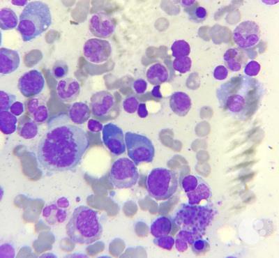 Multiple Myeloma-bone marrow 2