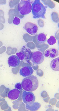 Multiple Myeloma-bone marrow 3