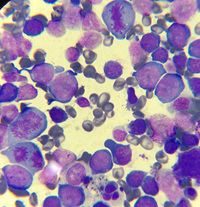 Megaloblastic anemia 1