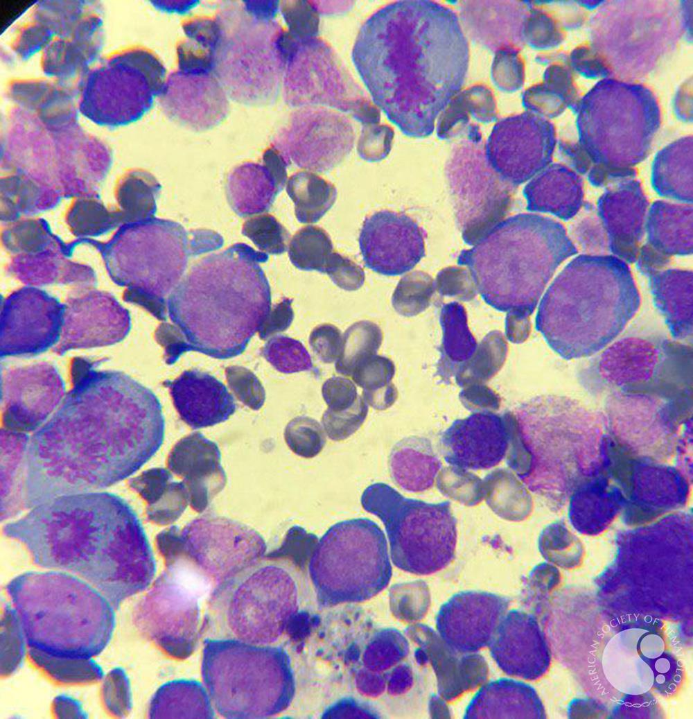 Megaloblastic anemia 1