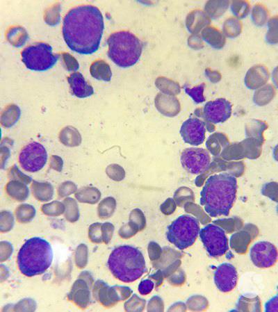 Megaloblastic anemia 2