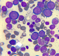 Megaloblastic anemia 3