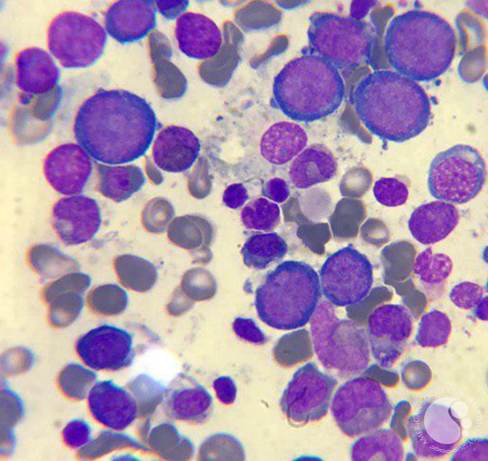Megaloblastic anemia 3