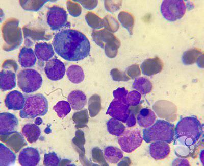 Megaloblastic anemia 4