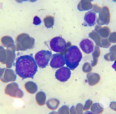 Megaloblastic anemia 5