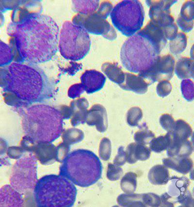 Megaloblastic anemia 6
