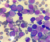 Megaloblastic anemia 7