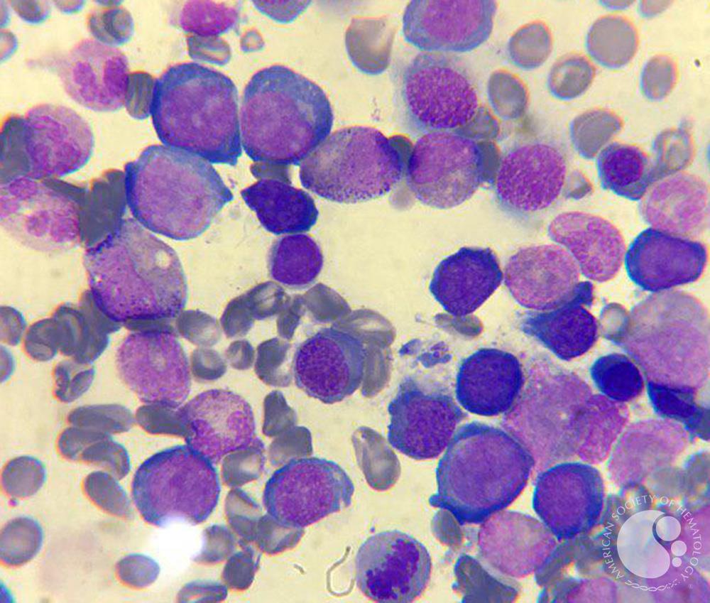 Megaloblastic anemia 7